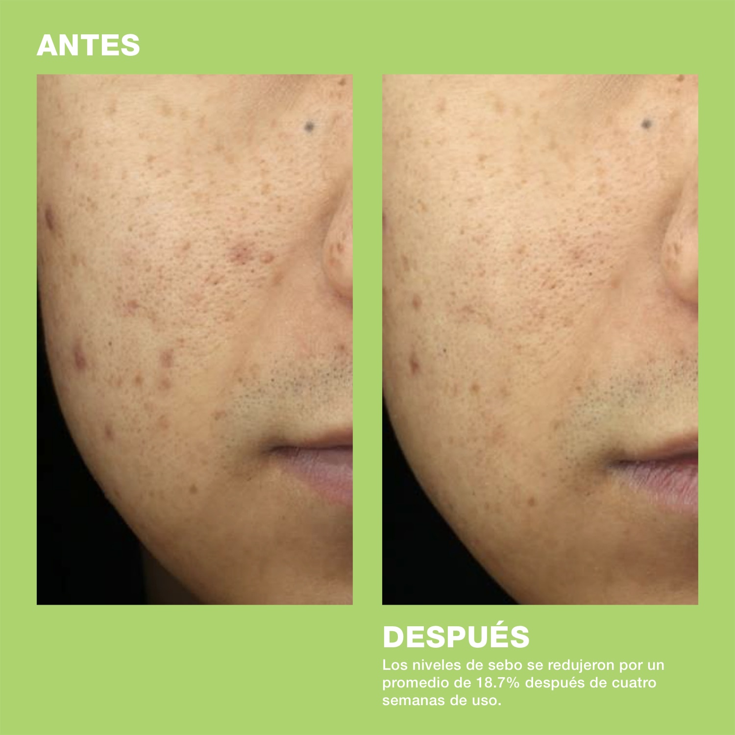 TEATREEMENT&trade; MOISTURIZER WITH TEA TREE (HUMECTANTE)